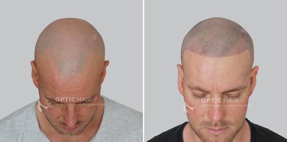 Haarpigmentierung-vorher-nachher-Ergebnis.jpg